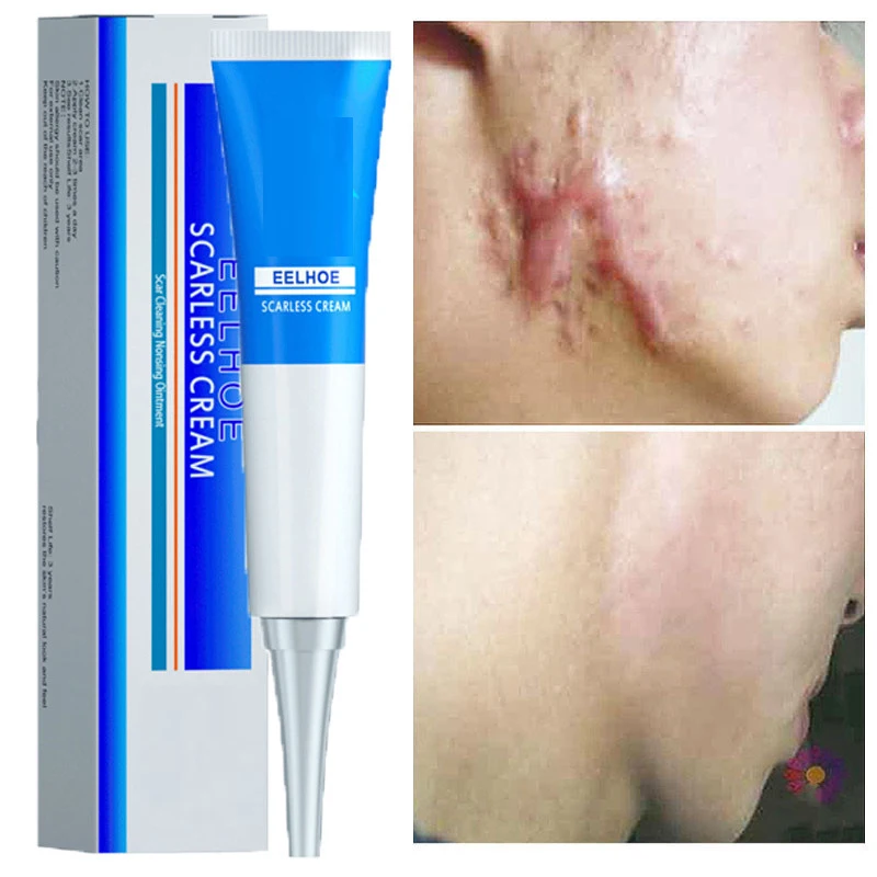 

Эффективный крем для удаления шрамов, гель, восстанавливающий, ожоговевший, хирургический, рубцов, кардиоидный крем для ухода за кожей