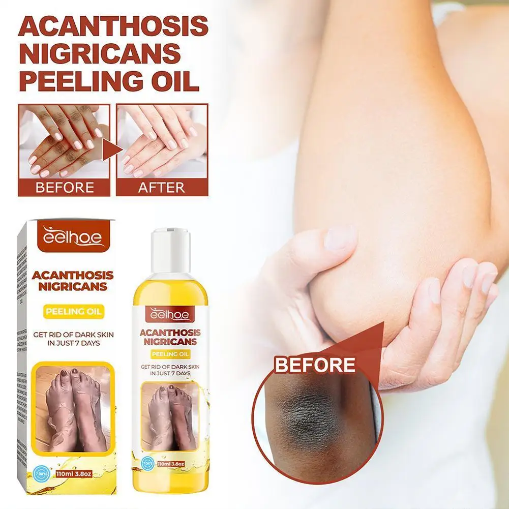 

110ml Acanthosis Nigricans Peeling Oil Lighten Elbows Skin Tone Knee Even Care Arm Skin Remove Legs Body Whiten E8A1