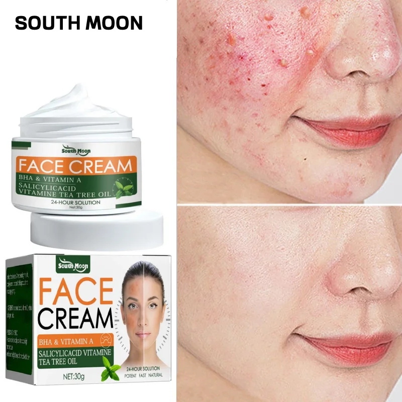 

Herbal Acne Removal Cream Anti Pimples Spots Face Gel Acnes Scar Treatment Shrink Pores Dark Dots Whitening Skin Care Products