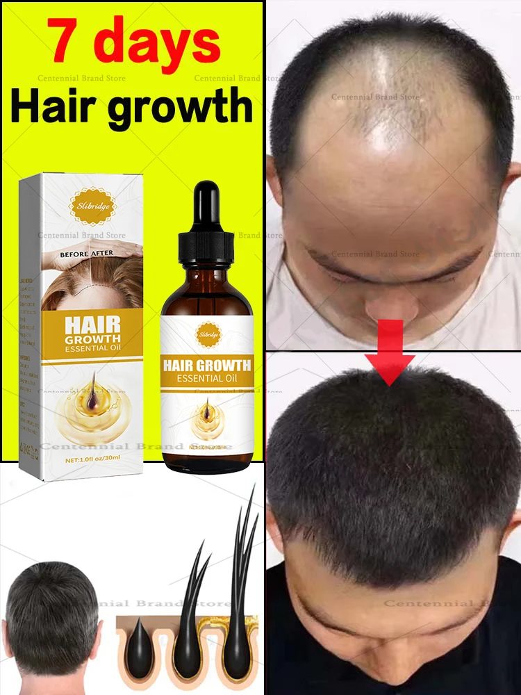 

Fast hair growth hair care scalp dryness prevention baldness treatment hair care oil ginger hair growth serum anti hair loss