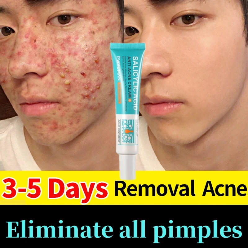 

Salicylic Acid Acne Cream Acne Gel Acne Marks Scars Black Spots Treatment Pore Shrinkage Oil Control Whiten Repair Products