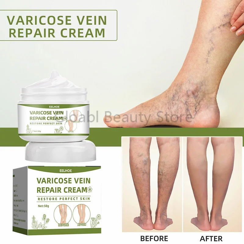 

Крем для восстановления варикозного расширения вен Tongmai, эффективное снятие боли в ногах, дождевой червь, красная кровь, шелк, паук, 50 г