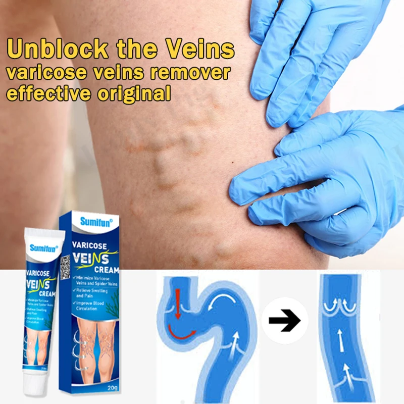 

1/2pcs 100% Original Varicose Veins Ointmnet Vasculitis Phlebitis Spider Pain Relief Ointment Medical Plaster Angiitis Removal