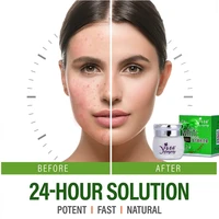 powerful acne conditioning cream controls oil unblocks pores suppressesremoves acne and prints whitening cream