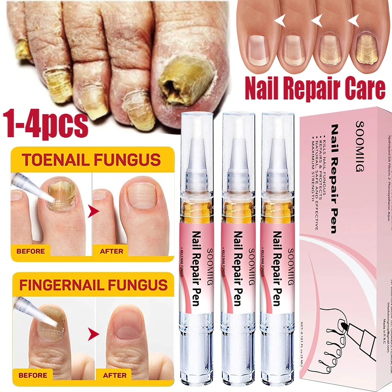 

Soomiig Nail Treatment Pen Onychomycosis Paronychia Anti Fungal Nail Infection Chinese Herbal Toe Fungus CareRepair Serum