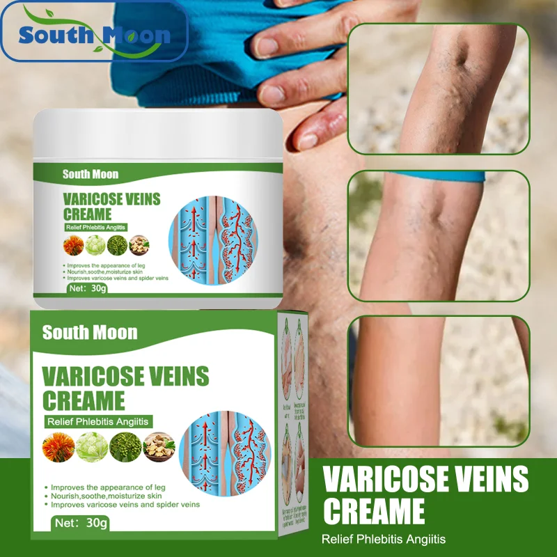 

Sdotter Varicose veins ointment leg vein bulge relief cream relieve red blood silk vasculitis phlebitis spider pain Massage trea