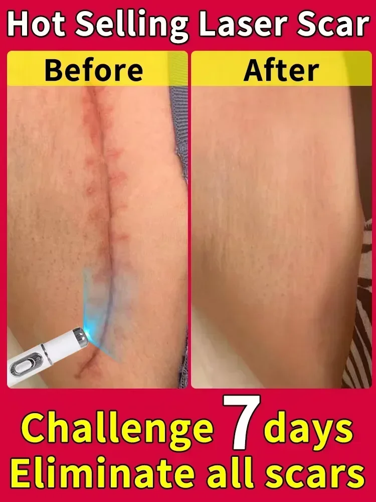 Лазерная терапия Keloid scAR