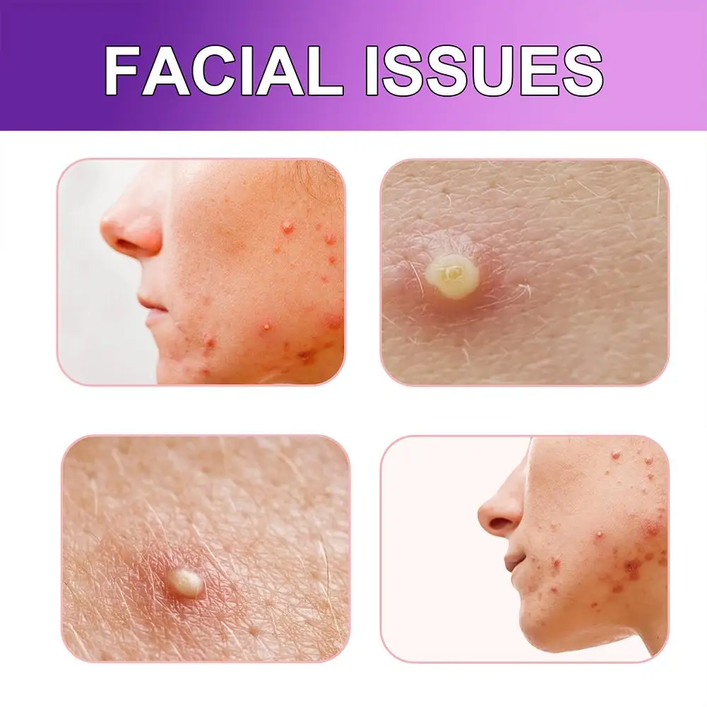 Маска для удаления акне невидимая водостойкая 180 шт.