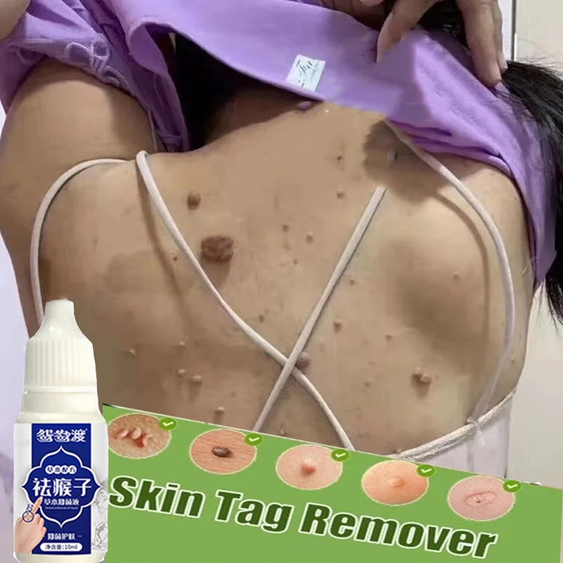 

1pcs Skin Tag Remover Genital Wart Treatment Instant Removal Mole&Papillomas Foot Corn Repair Natural Bacteriostatic Liquid