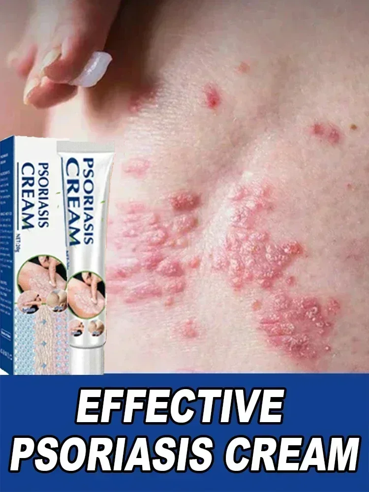Новый лучший продукт против дерматита при псориазе и экземе Лечение: натуральный