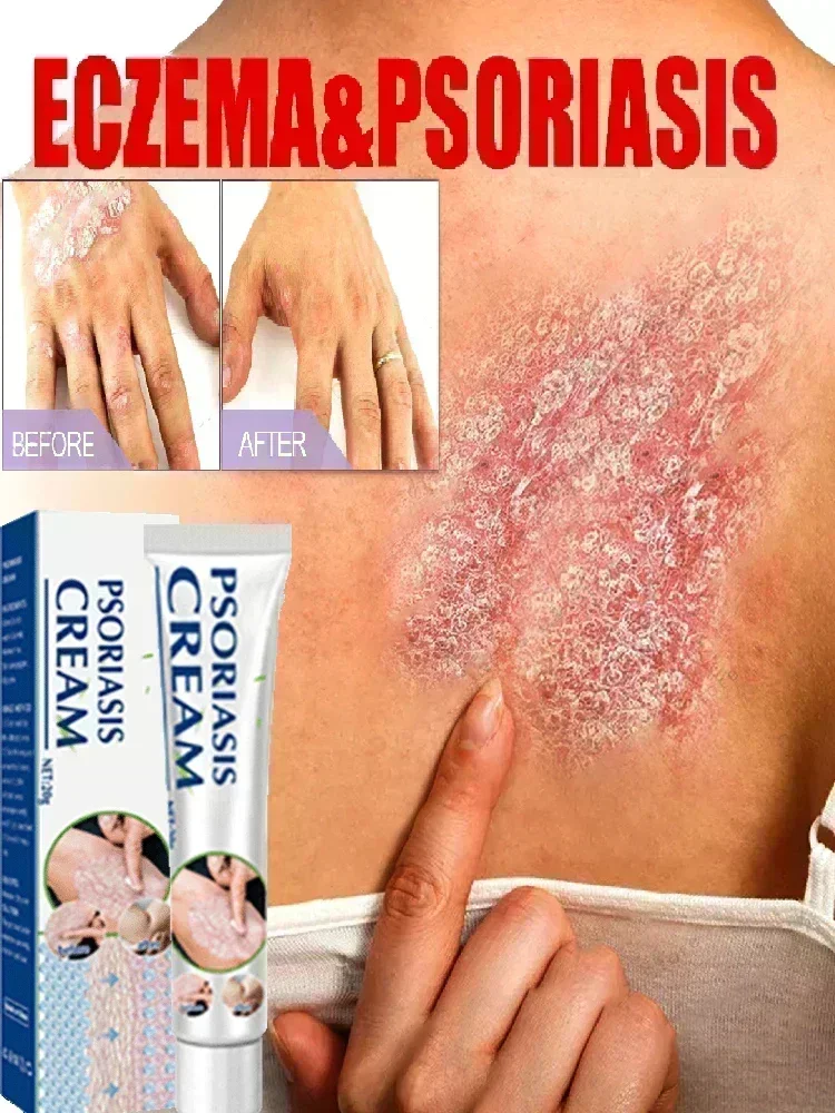 Новый лучший продукт против дерматита при псориазе и экземе Лечение: натуральный