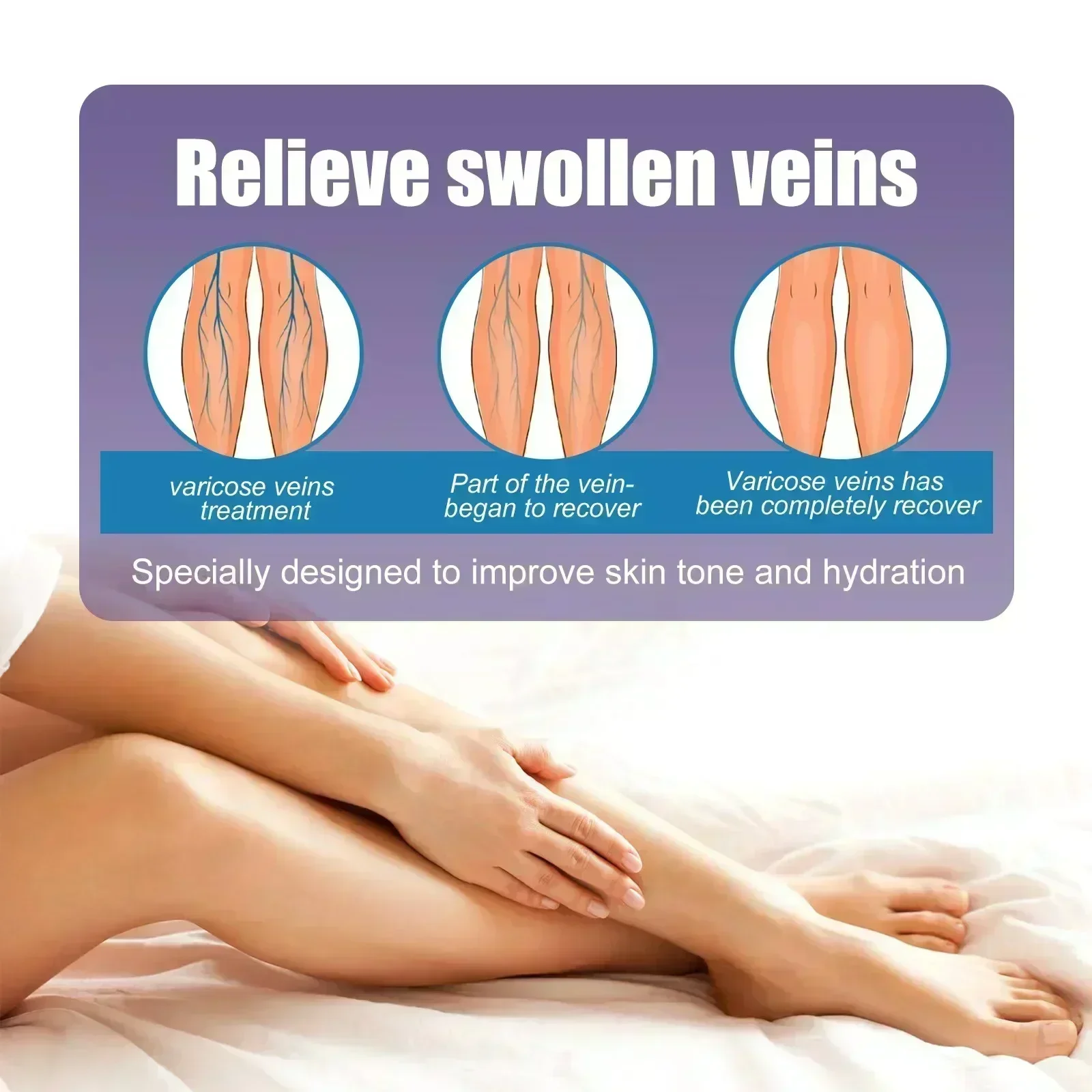 Varicose Veins cream Natural Herbal Skin Improved Blood Circulation Swelling Relief and Spider Vein Treatment