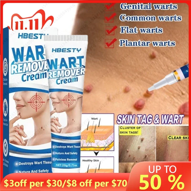 

Removing Against Moles Cream Treatment Papillomas Removal Warts Cream From Skin Tags Remover Anti Verruca Remedy Dropshipping