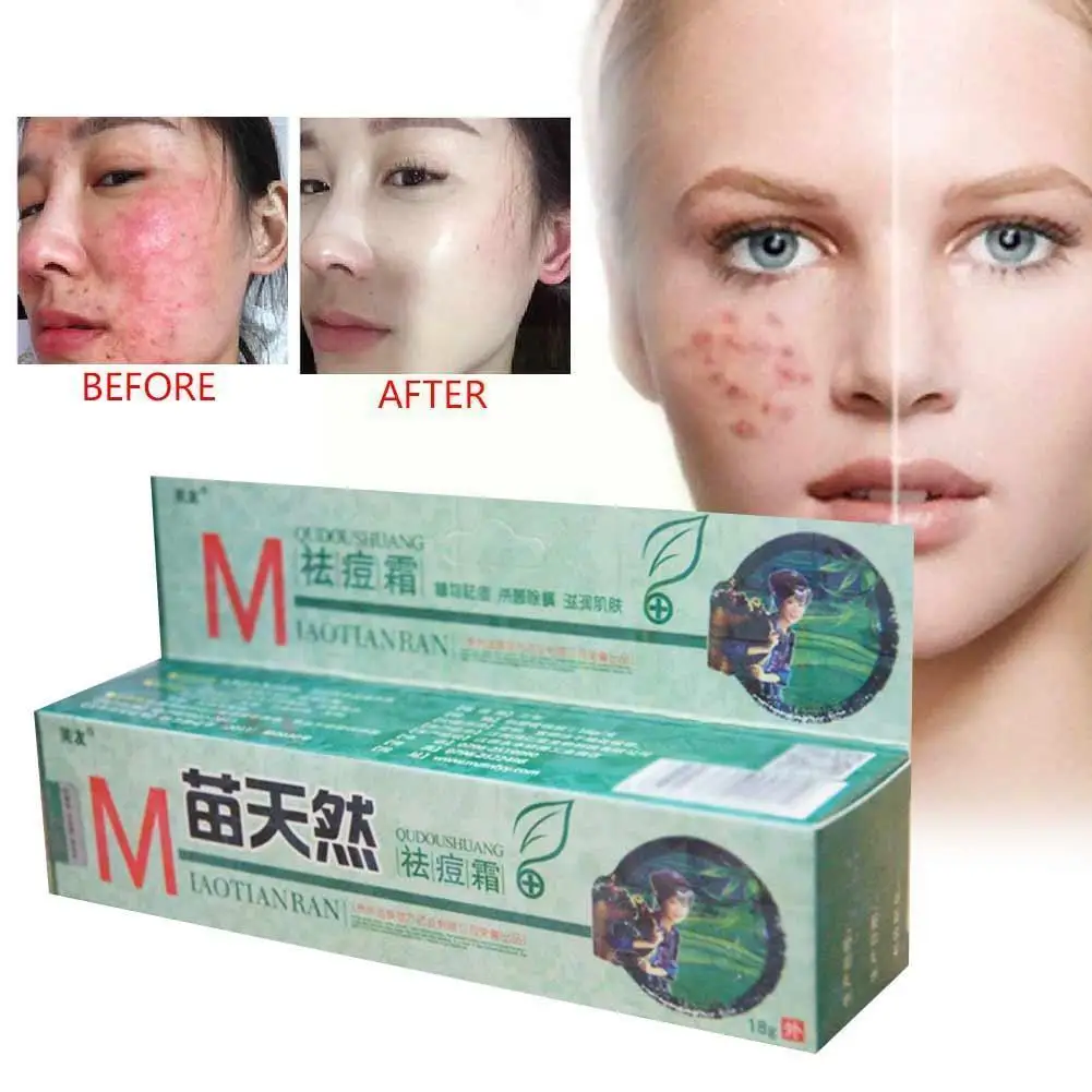 

Chinese Natural Herbal Remove Acne Cream Germicidal Moisturizeing Skin Mite Acne Ointment Cream Treatment Care 18g Remove S7k5