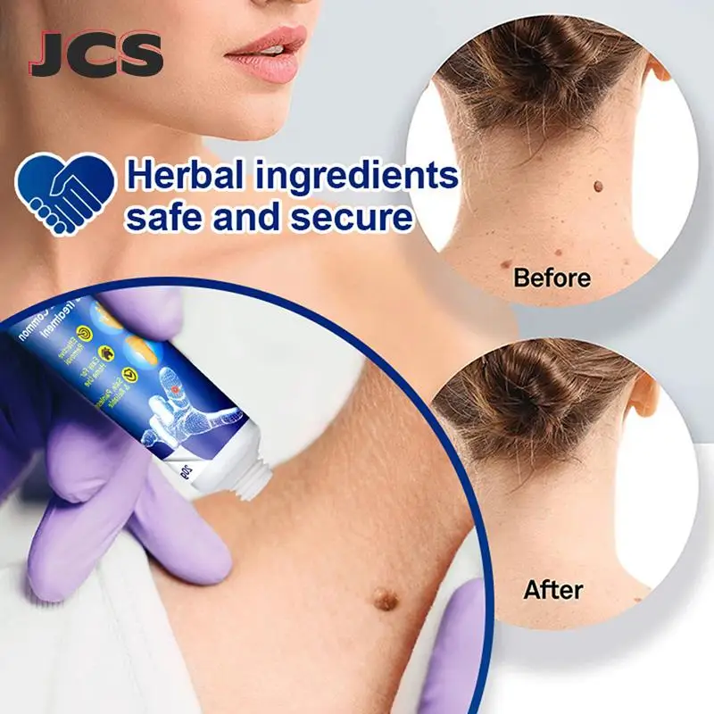 

1 шт., инструмент для удаления бородавок и бородавок