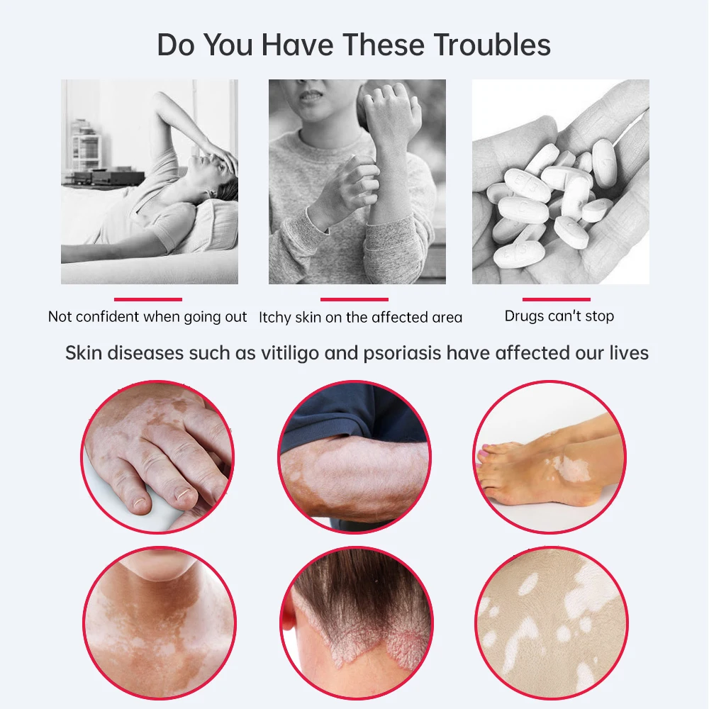 311 нм УФ-лампа для лечения витилиго и псориаза оборудование физиотерапии