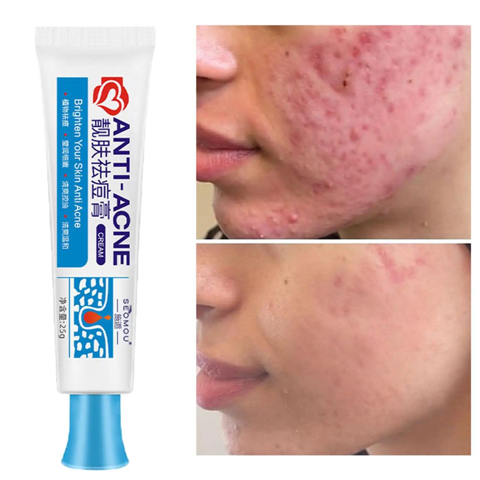 Acne Removal Cream Pimples Scar Treatment Facial Cream Oil Control Shrink Pores Whitening Moisturize Skin Care Beauty Health