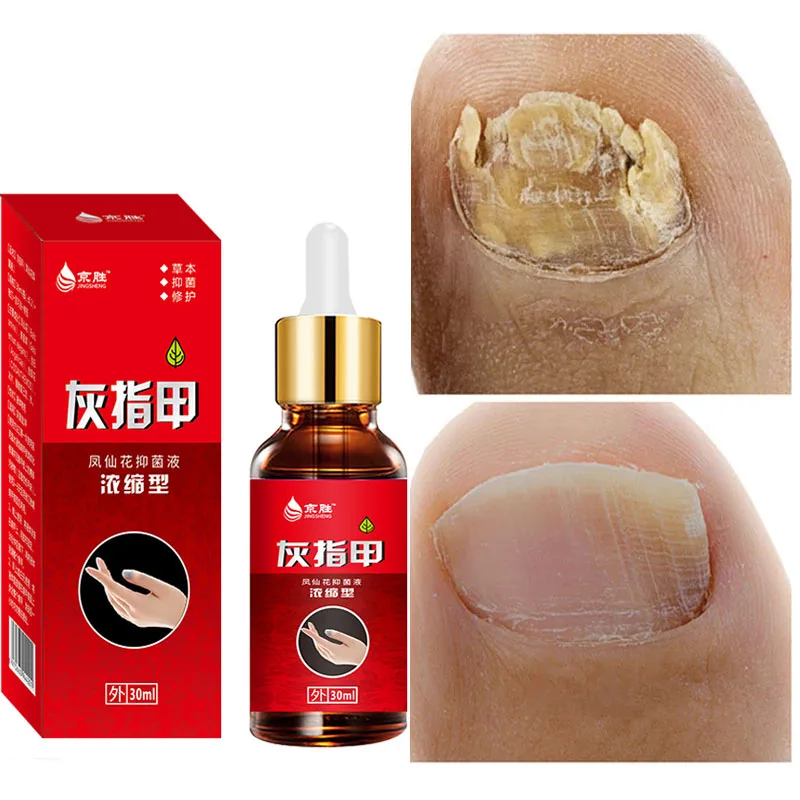 

Nail Fungal Treatment Feet Care Essence Nail Foot Whitening Toe Nail Fungus Removal Gel Anti Infection Paronychia Onychomycosis