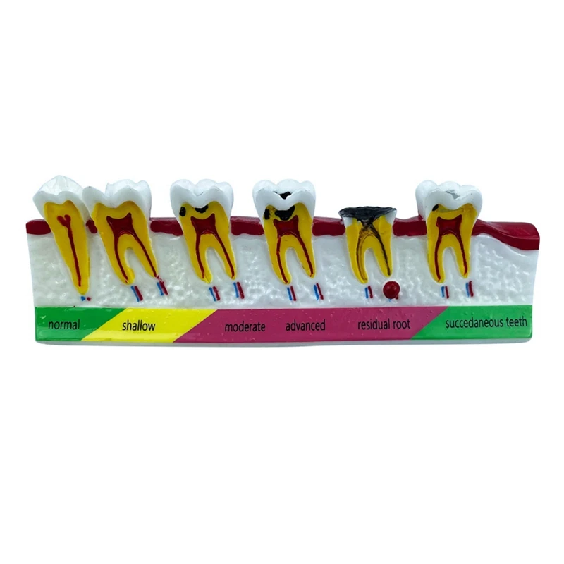 

Модель зубной кариес, эволюционная модель, патологический процесс для орального обучения