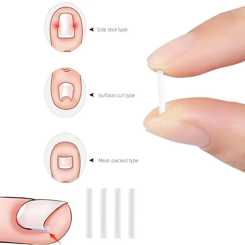 

Toenail Straightening Clip Ingrown Toenail Correction Tool Nail Treatment Elastic Patch Sticker Foot Care Pedicure 10pcs/pack