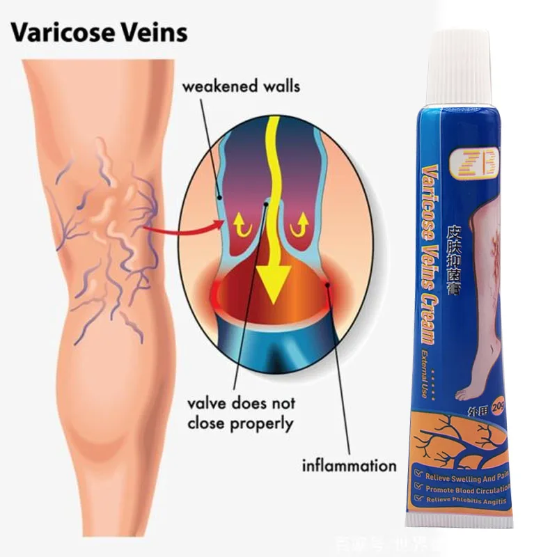 

20g Varicose Veins Cream Spider Vein Pain Relief Medical Ointment Vasculitis Phlebitis 100% Original Effective Treat Dressing
