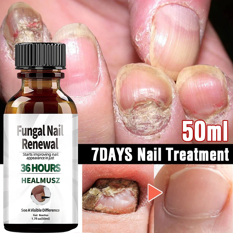 

Fungal Nail Treatment Serum Onychomycosis Paronychia Anti-Fungal Nail Infection Herbal Toe Fungus Foot Repair Essence Care 50ml