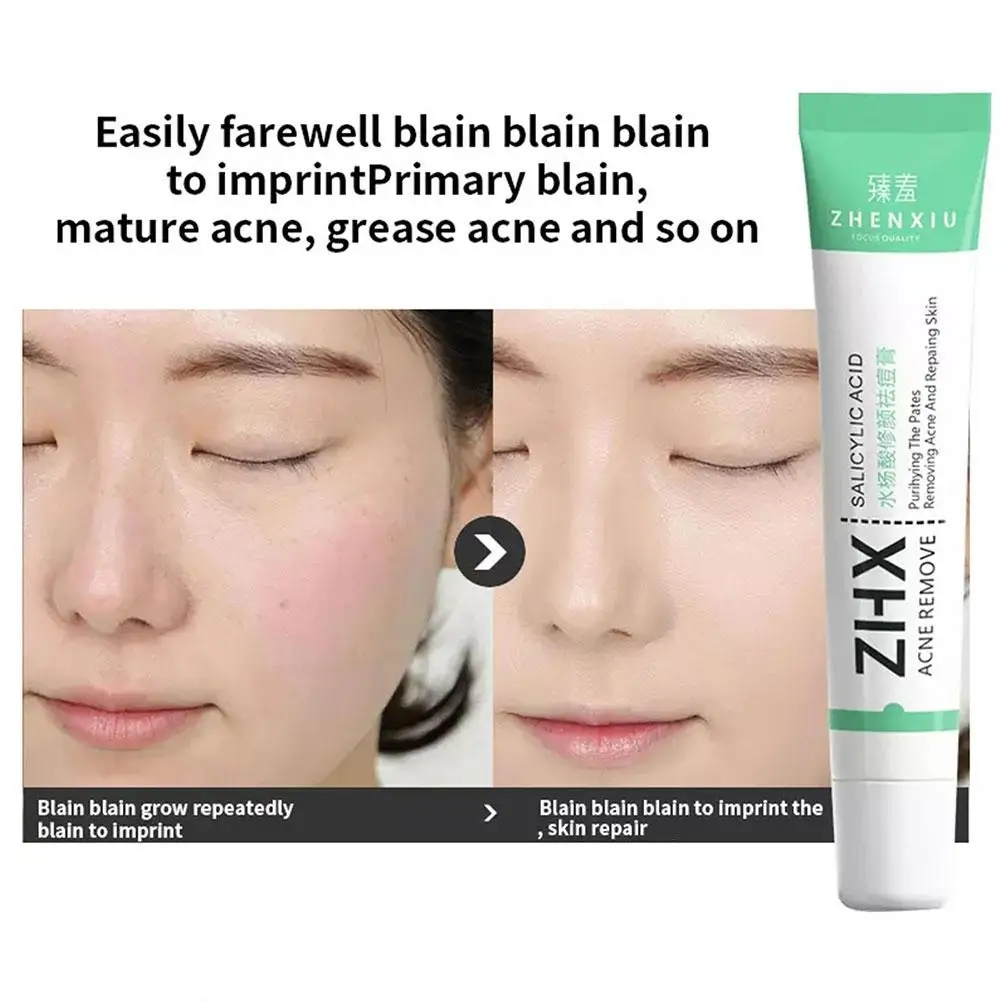 Крем для удаления акне с салициловой кислотой