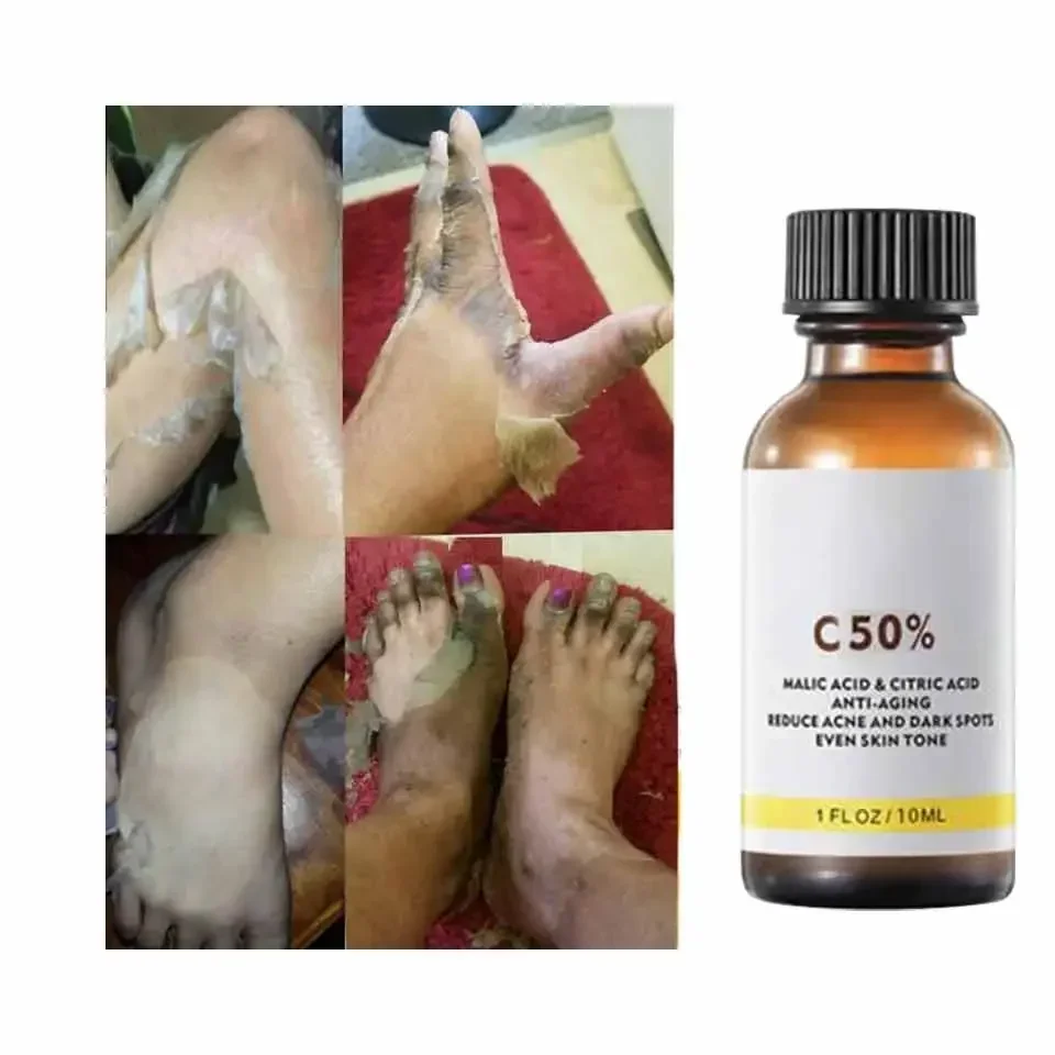 Высококачественная химическая пигментация осветление лечение акне удаление