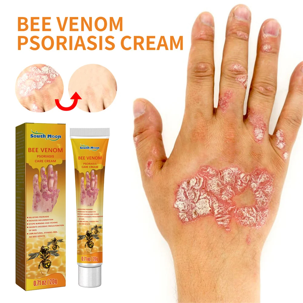 

Psoriasis Cream Removal Psoriasis Eczema Best Against Psoriasis Dermatitis Products Natural Plant Extracts for Psoriasis Remove