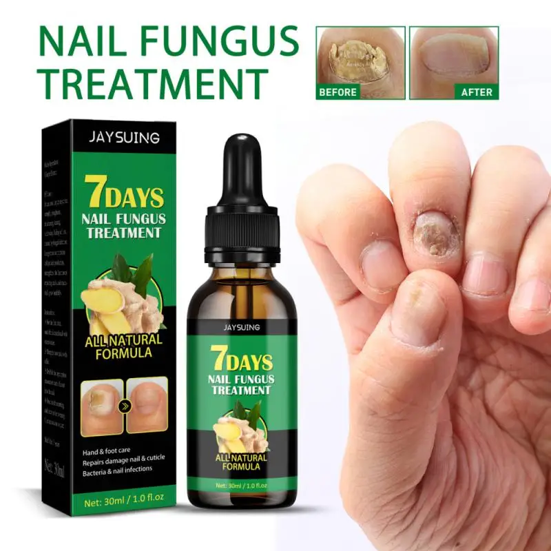 

Remove Onychomycosis Care Repair Liquid Professional Anti-fungal Nail Care Solution Foot Healthy Nail Care Soft Nail Moisturizer