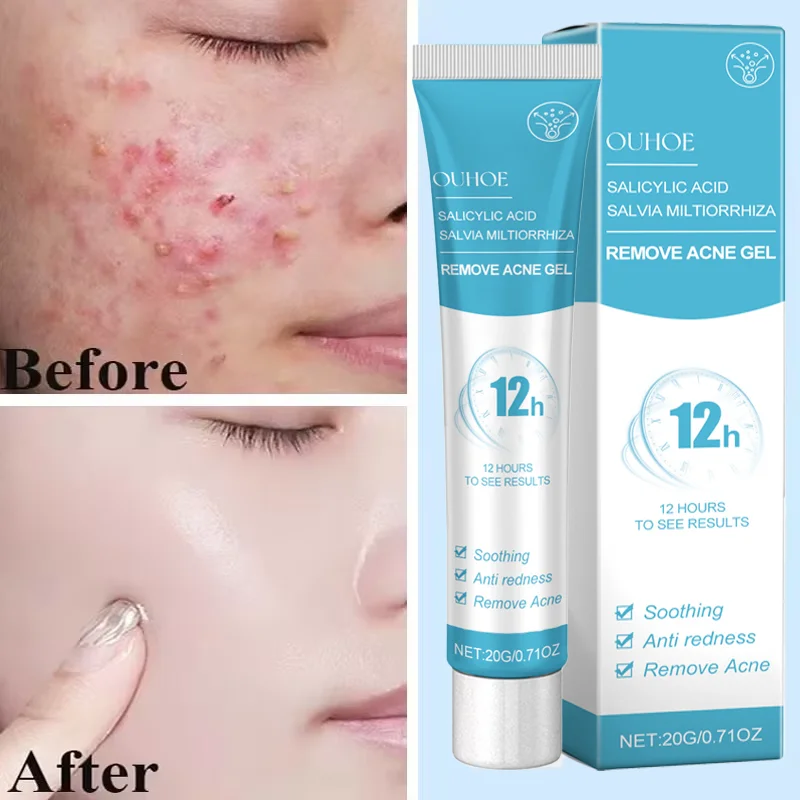 Крем от прыщей для лица средство удаления сужение пор контроль жирности