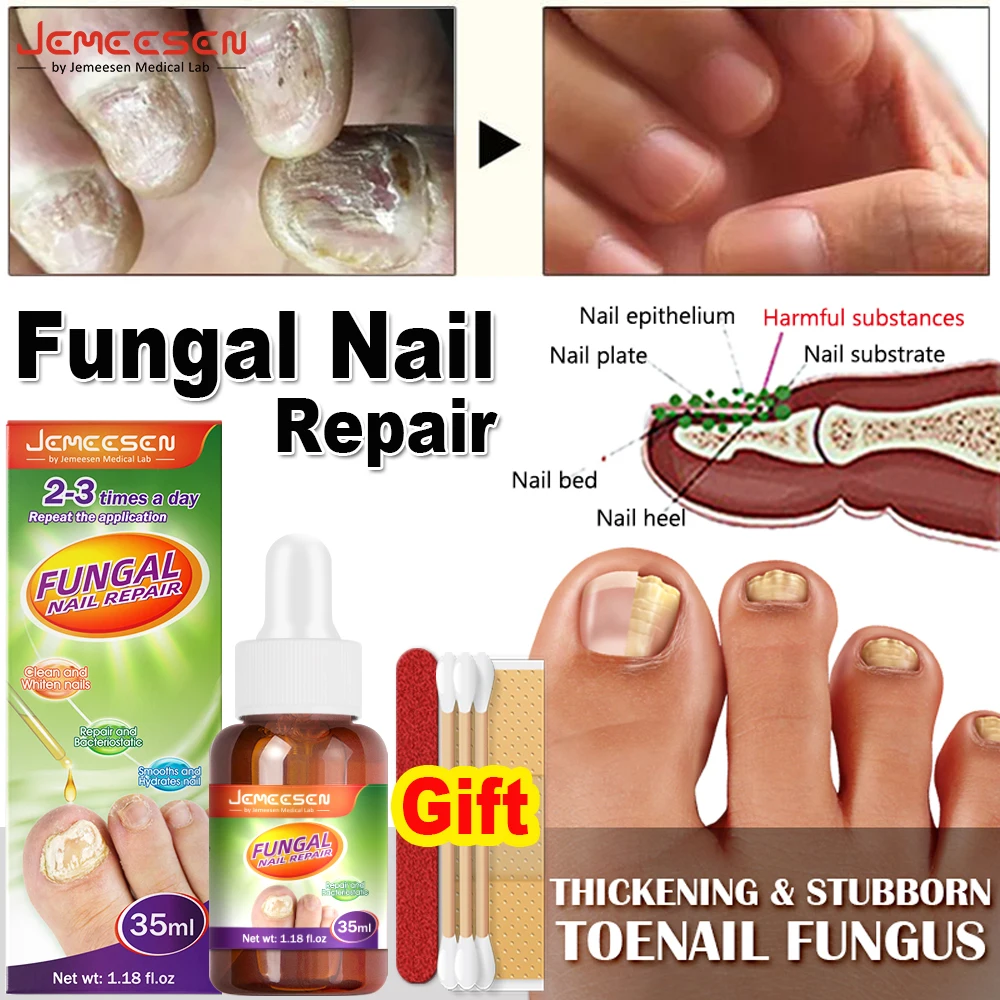 

Fungal Nail Serum Toenails Fungus Liquid Anti Infection Remove Onychomycosis Paronychia Treatment Toe Nail Fungus Hand Foot Care