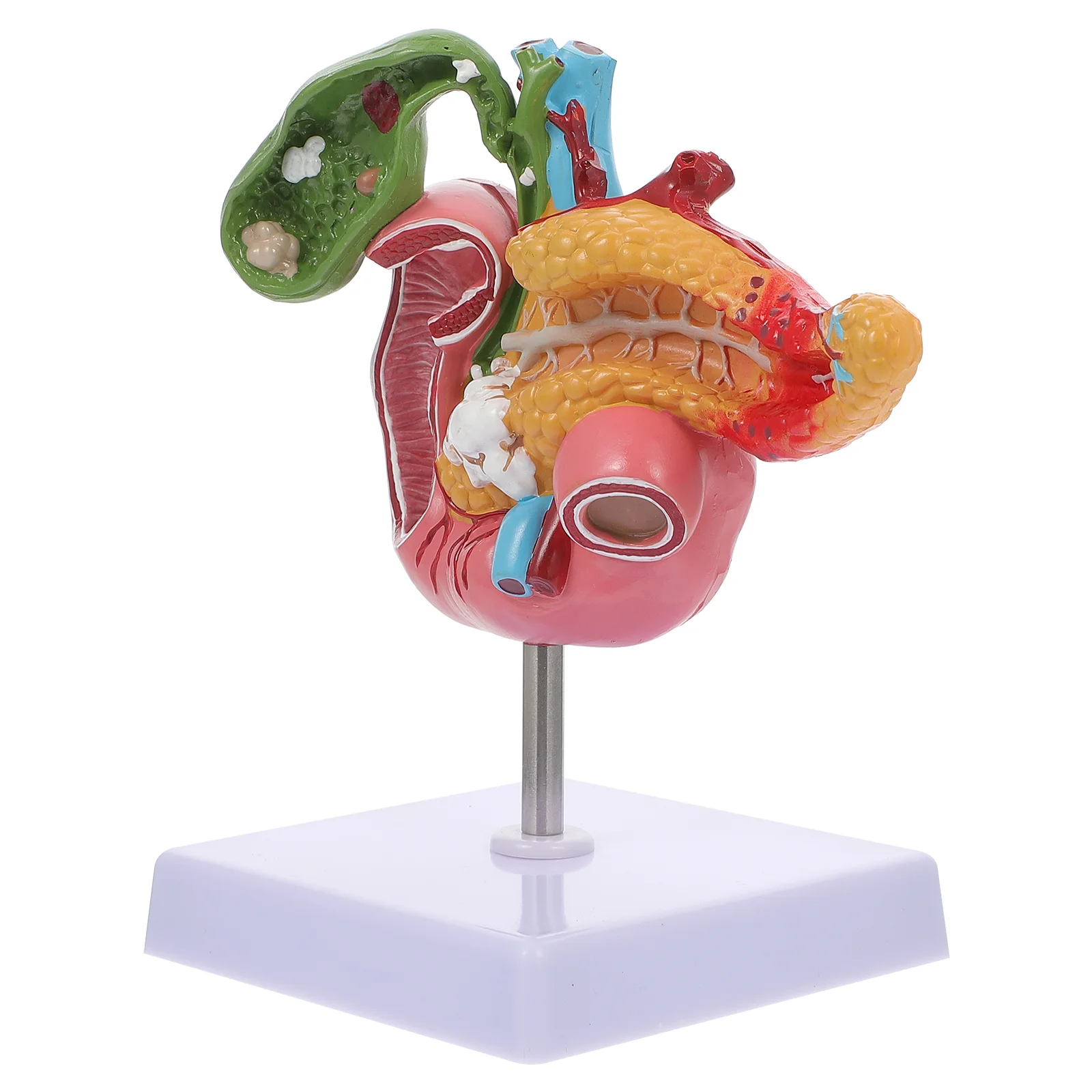 

Патологическая модель желчного пузыря человеческой поджелудочной железы, дуоденальный Lesion, анатомический аппарат, желчный камень, пищеварительная система