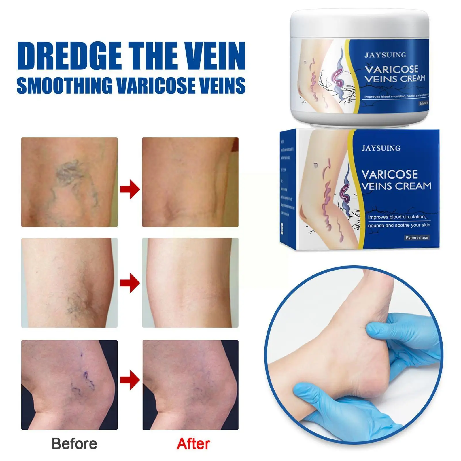 

Varicose Veins Cream, Varicose Vein Soothing Leg Cream Spider Health Treatment, Capillary Strengthen Veins Varicose Natural L0C7
