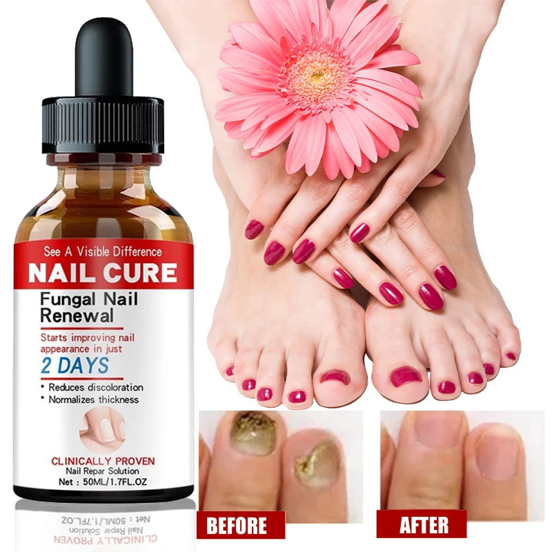 

Nail Fungus Treatment Toenail Health Care Solution Fix & Renew Damaged Onychomycosis Diseased Nail Loss and Regeneration