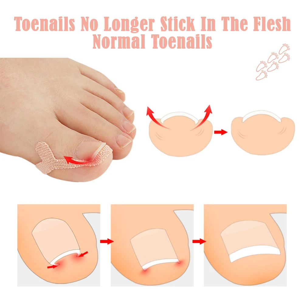 

2 упаковки, корректор для вросших ногтей