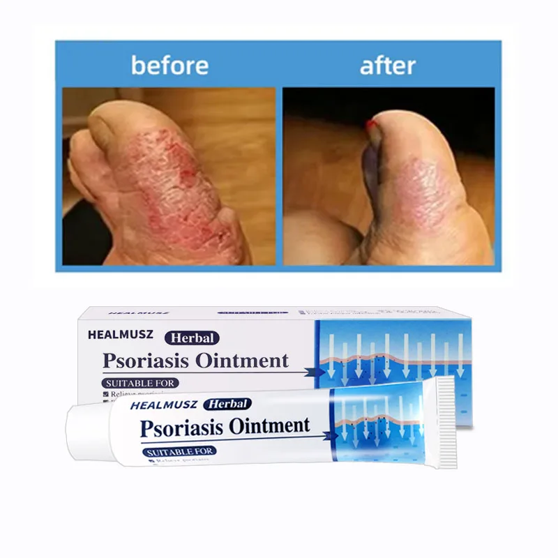 5/10 шт. пластырь для ухода за кожей крем от псориаза лечение дерматита экземы