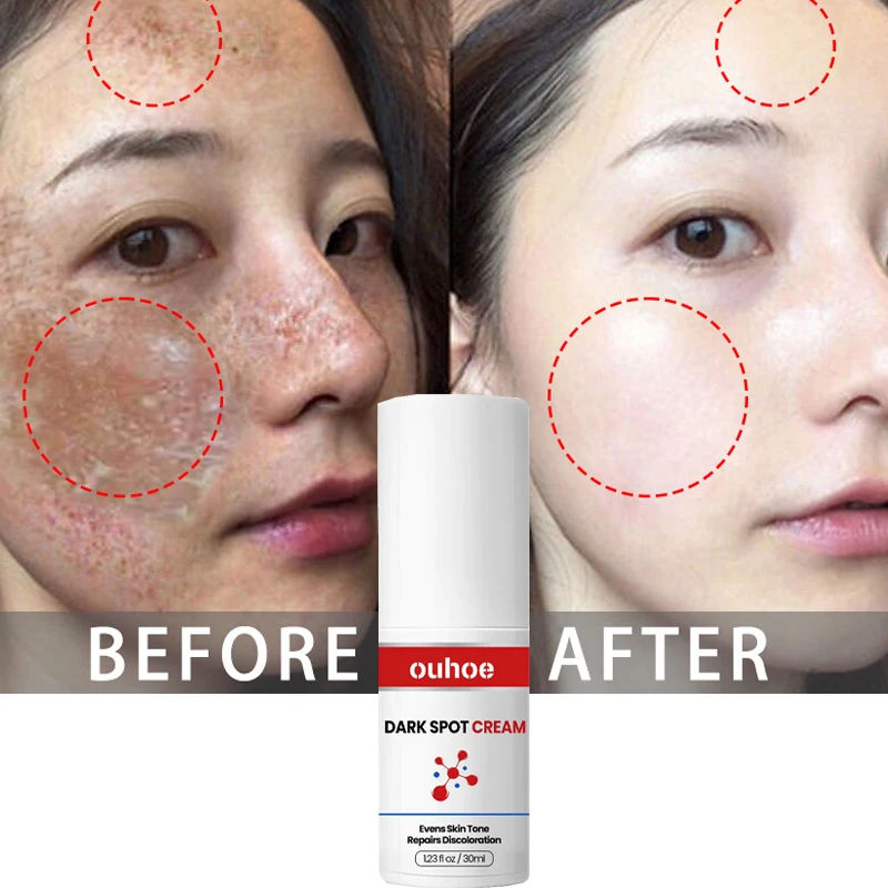 Powerful Dark Spot Remover Cream Whitening Freckle Lotion Lighten Melanin Repair Dull Fast Brightening Face Korean Cosmetics