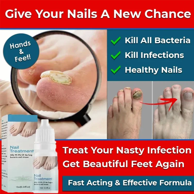 Новинка 10 мл онихомикоз для ремонта - Цена: 5049