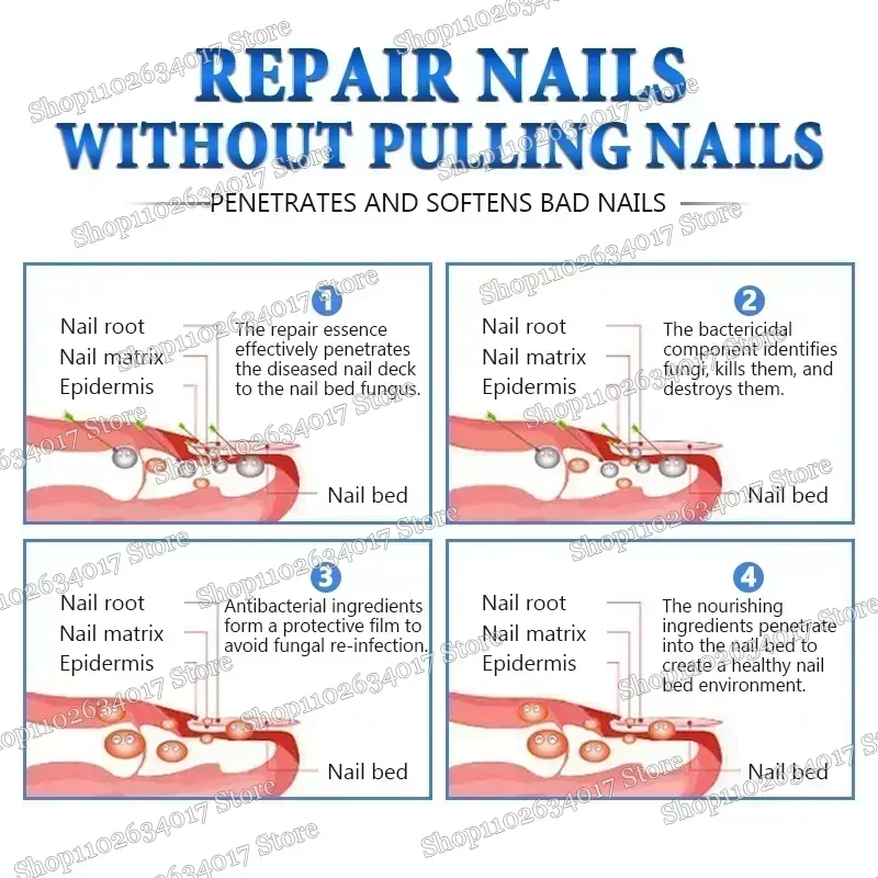 Раствор для восстановления ногтей утолщение яркие ногти удаление онихомикоза