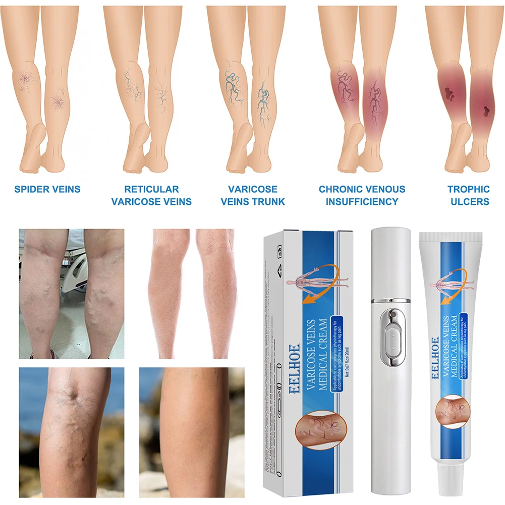 

Varicose Veins Treatment Cream Vasculitis Relief Phlebitis Angiitis Inflammation Blood Vessel Legs Varicose Veins Ointment