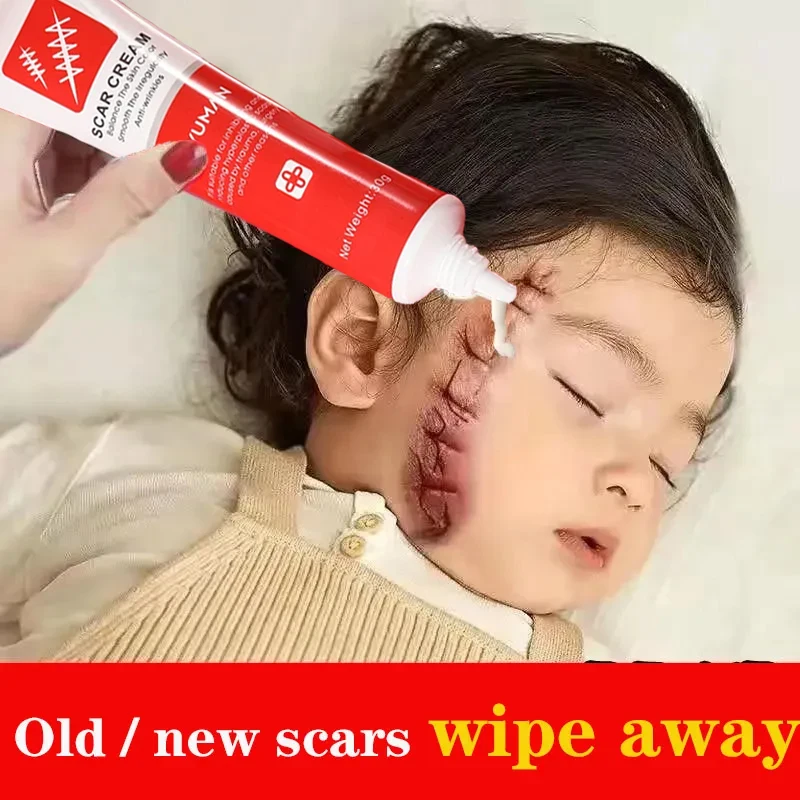 

Fast Scar Removal Cream Treatment Stretch Marks Burn Surgical Scar Ointment Repair Gel Fade Acne Spot Whitening Smooth Skin Care