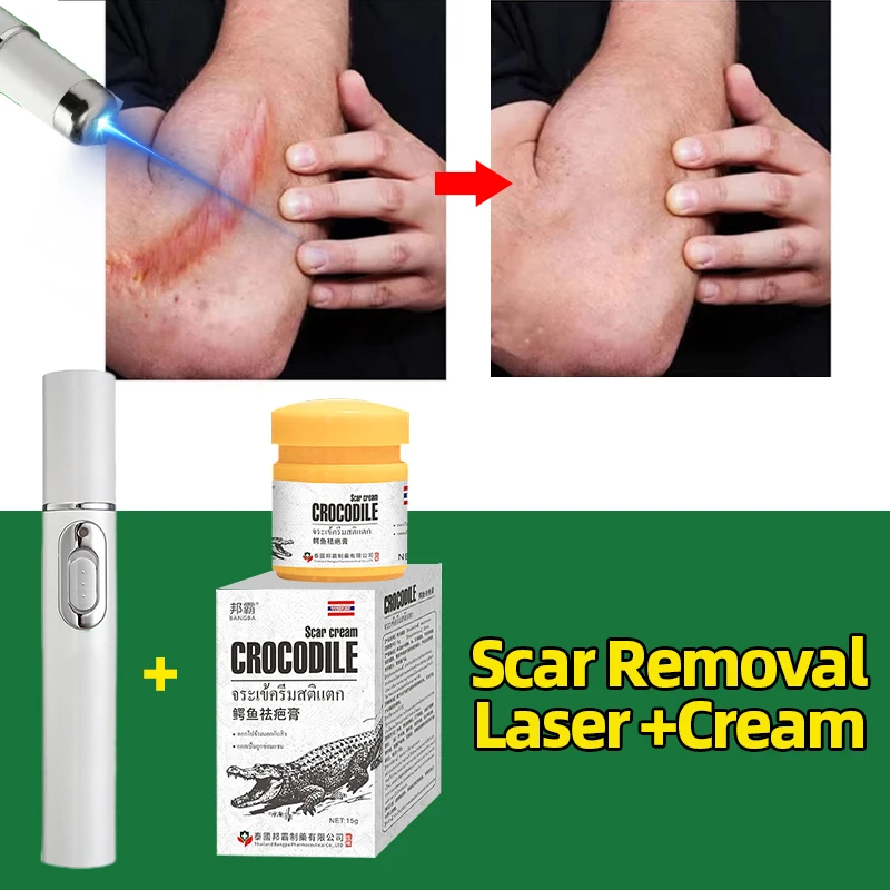 Лазерная ручка для удаления шрамов с синим светом портативная лазерная защита от