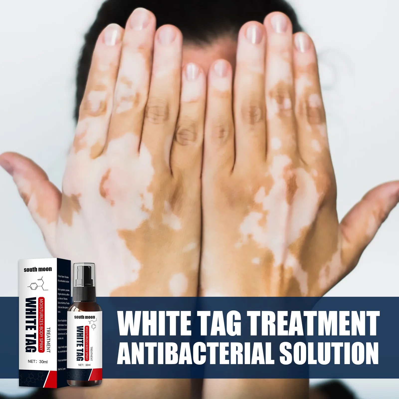 

White Spot Remover Spray Herbal Antibacterial Vitiligo Treatment Serum Leukoplakia Disease Pigment Melanin Repair Body Face Care