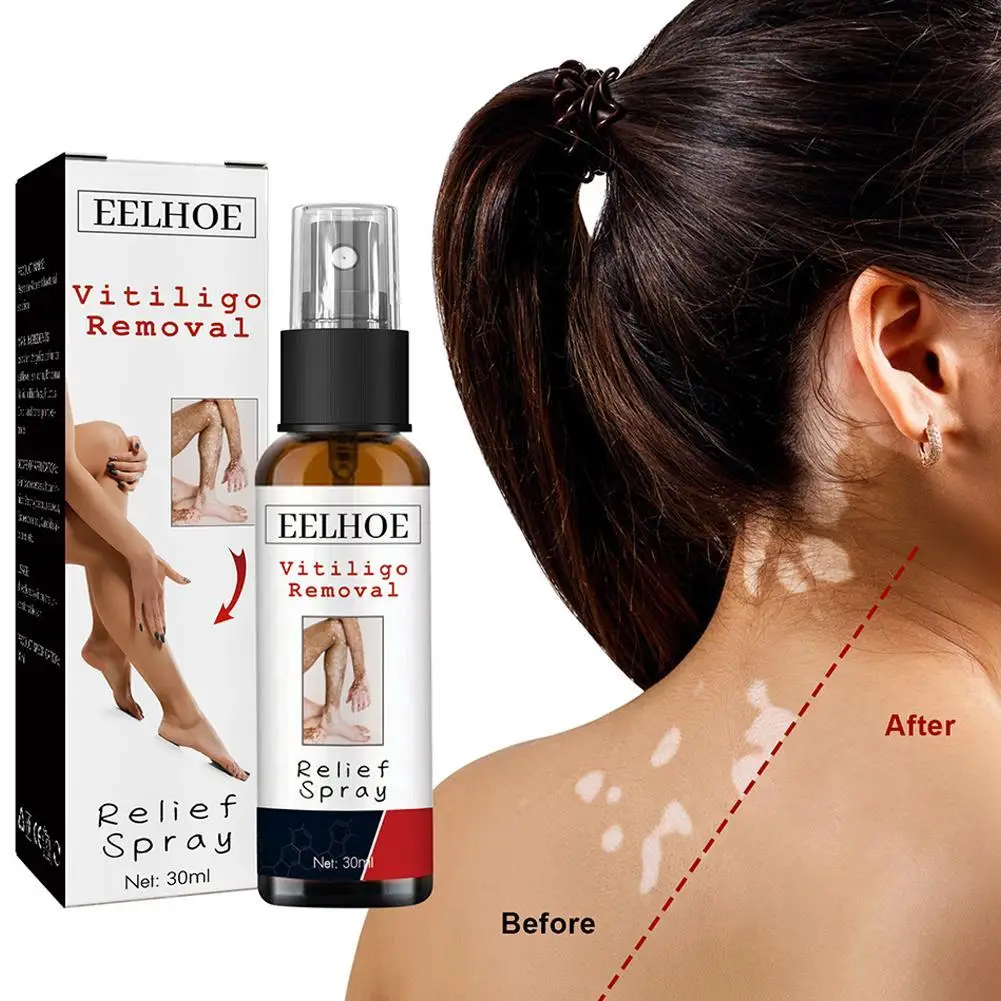 

30ml Vitiligo Relief Spray Skin Moisturizing Vitiligo Net Spray Skin Repair Body Face Fades Vitiligo Spot White Spots Repair