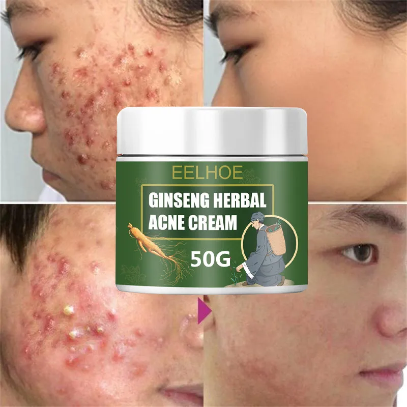 

50g Acne Removal Cream Treatment Acne Scar Shrink Pores Oil Control Whitening Moisturize Face Ginseng Herb Acne Skin Care