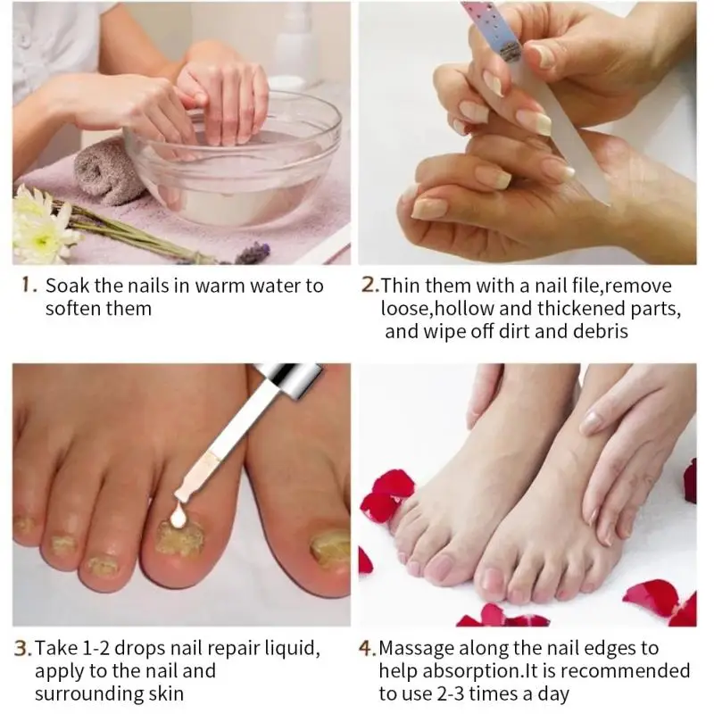 

1-5 шт., антигрибковые ногти для восстановления ногтей
