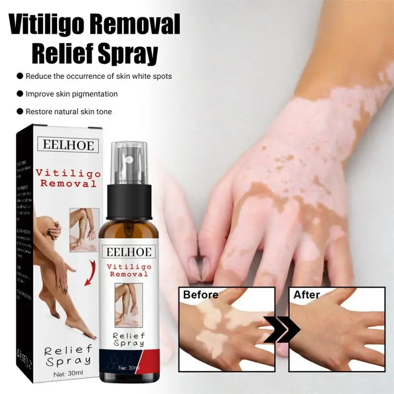 

30ml Vitiligo Relief Spray Skin Moisturizing Vitiligo Net Spray Skin Repair Body Face Fades Vitiligo Spot Repair Body Care 1/2PC