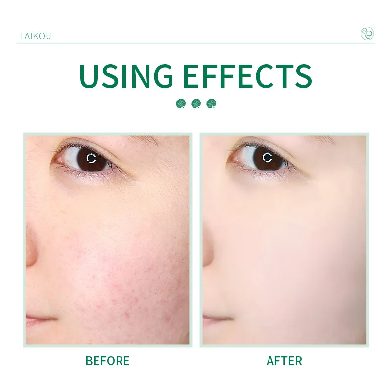 Успокаивающее средство для лица LAIKOU Centella аминокислота удаление черных точек