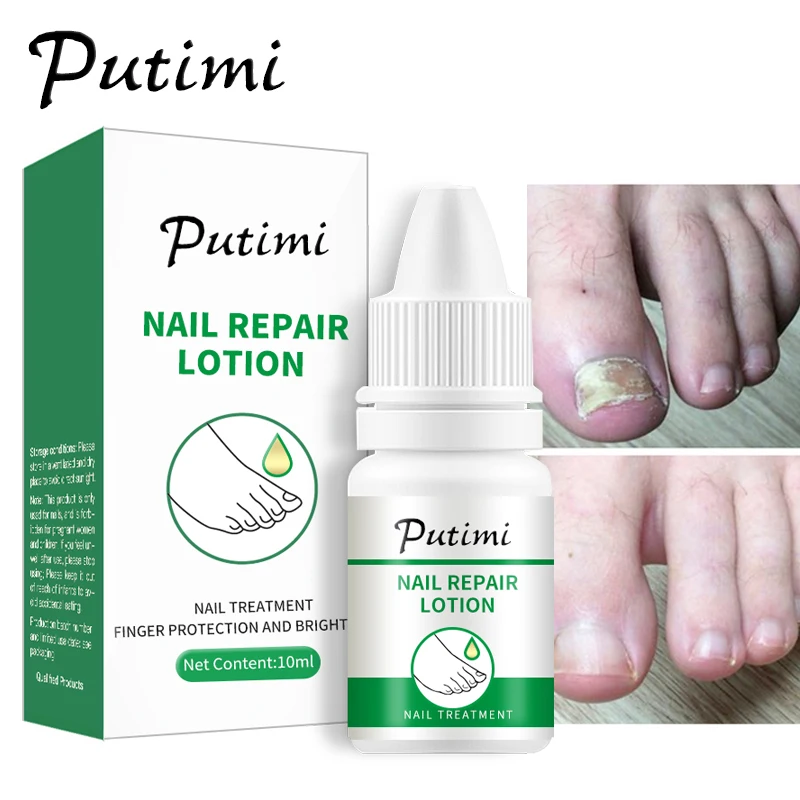 

PUTIMI Anti Infection Fungal Nail Treatment Foot Care Essence Whitening Toe Nail Fungus Removal Gel Paronychia Onychomycosis